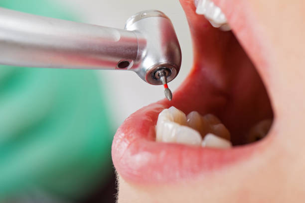 Best Cracked Tooth Emergency Dentist  in Lake Morton Berrydale, WA